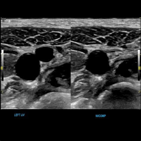 Upper Extremity Venous Ultrasound Template