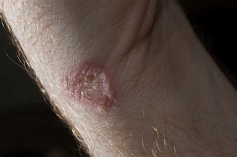 15 Most Common Symptoms Of Ringworm