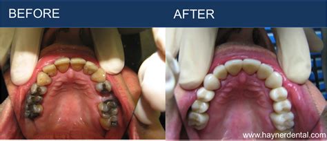 Hayner Dental Restorative Dentistry Before And After Hayner Dental