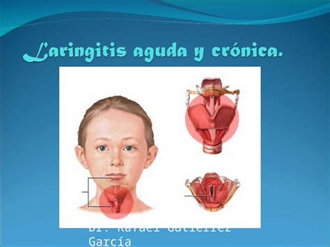 Ppt Laringitis Aguda Y Crónica Dr Rafael Gutierrez