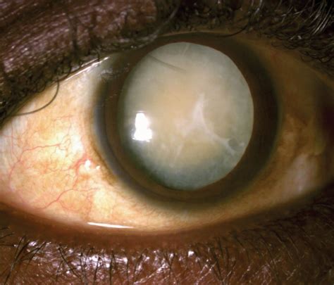 Mature Cataracts Obscure Retinal Pathology