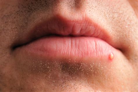 Cold Sore Or Pimple How To Tell What The Bump On Your Lip Really Is