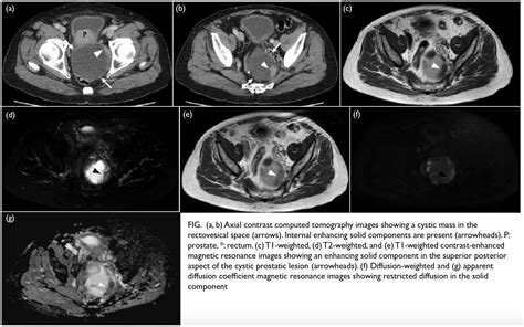 Cystic Prostatic Carcinoma Case Report And Literature Review Hkmj