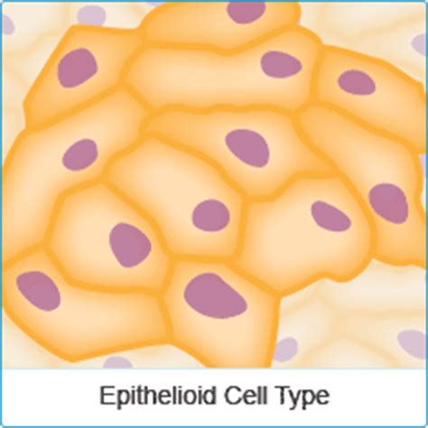 Related online courses on physioplus. Mesothelioma Cell Types - Epithelioid, Sarcomatoid and ...