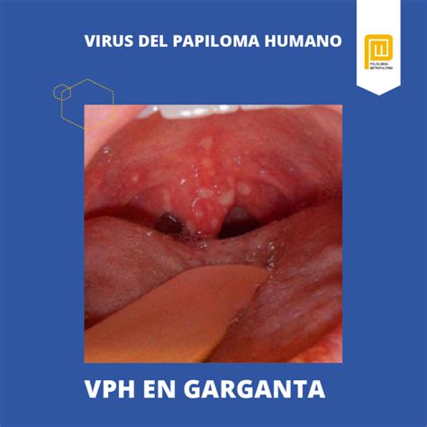 Virus Del Papiloma Humano S Ntomas Y Tratamiento Policl Nica Metropolitana