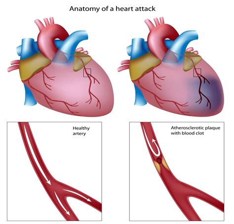 Myocardial Infarction Dr Debargha Dhua Mbbs Md Dm Cardiology