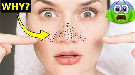 Why Black Dots On Face Blackheads Blackhead Removal Face Cream