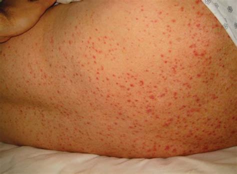 Body rash or skin rash is an inflammation on the skin and cause itching, burning, stinging and pain. Home Remedies for Prickly Heat Rash - Starsricha