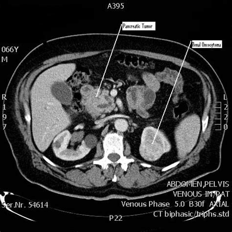 Ct Scan Of The Abdomen Showing The Pancreatic Tumor And