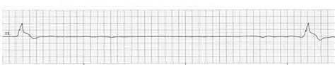 Float Nurse: EKG Rhythm Strips 91 Various Agonal Rhythms