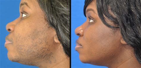 Laser Hair Removal Before And After Face