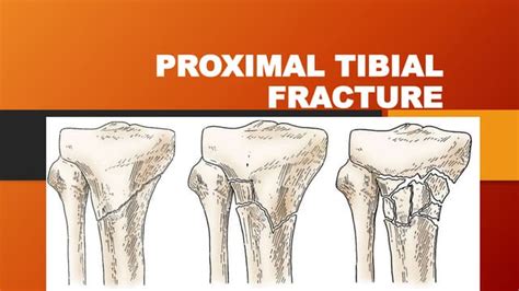 Proximal Tibial Fracturepptx