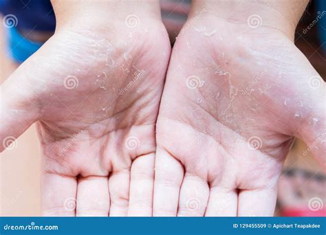 Hand Skin Peeling Due Stock Image Image Of Medical 129455509