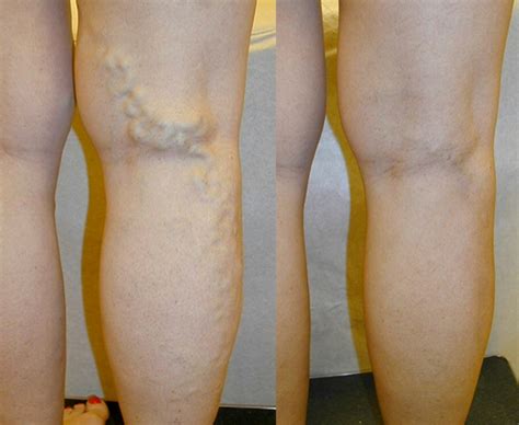 Varicose Veins Treatments Before And After Pictures