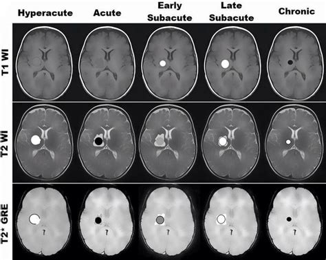 Stages Of Cerebral Hemorrhage The Appearance And Evaluation Of