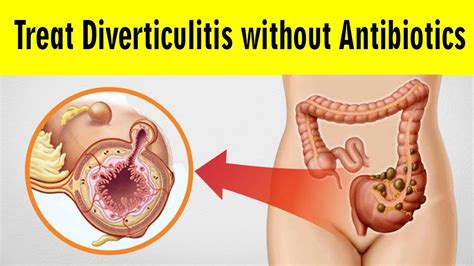 Antibiotics help treat or prevent a bacterial infection. How to treat Diverticulitis without Antibiotics | 9 Home ...