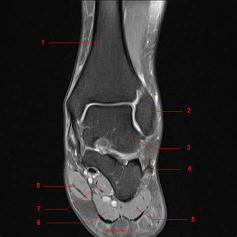 Lateral and medial processes of calcaneal. Immagini coronali T2 FATSAT della caviglia