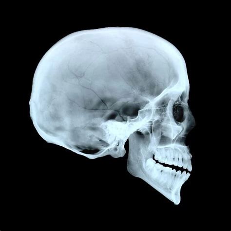 Adult Human Skull Side View X Ray Showing The Cranium Photos Framed