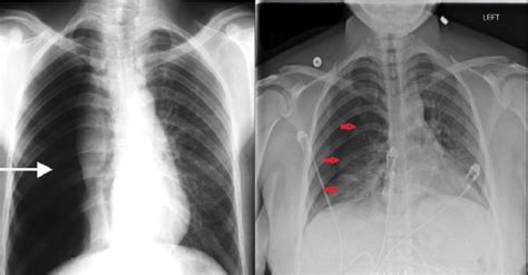 Chest X Ray Showing Large Right Pneumothorax With Collapsed Lung