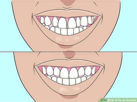 Invisalign treatment is the clear alternative to metal braces for kids, teens, and adults. How to Fix an Overbite: 9 Steps (with Pictures) - wikiHow
