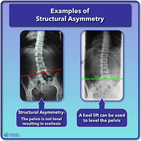 What Is Scoliosis Scoliosis Defined And Its Causes Scoliosis Care Centers