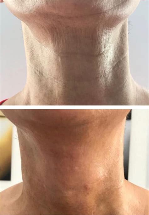 Neck Wrinkles Case Study Sagging Skin Treatment London Based