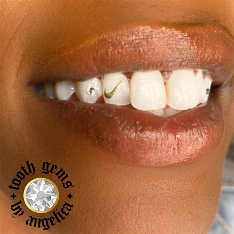 Where Can I Get Permanent Gold Teeth Near Me Abevegedeika