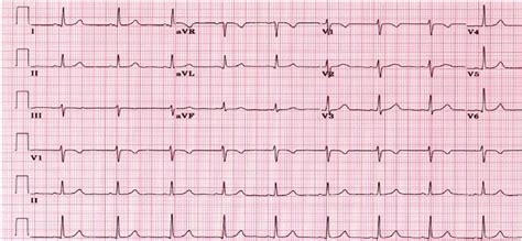 An Example Of Normal Ecg From 6 Leads Download Scientific Diagram
