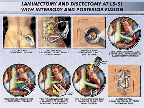 Laminectomy And Discectomy At L5 S1 With Fusion Order