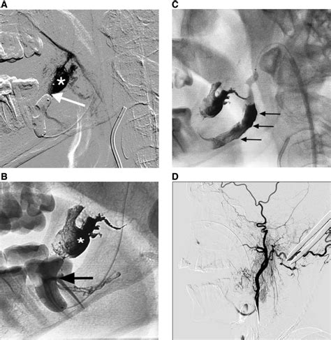 Transvenous Balloon Assisted Onyx Embolization Of Mandibular Avm A