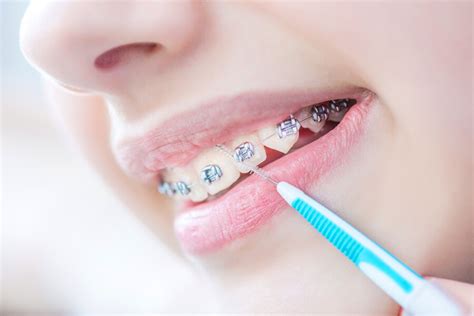 When you have braces, be sure to pick a toothpaste that has fluoride. The Right Way to Clean Your Braces | Valderrama Orthodontics