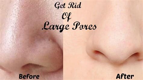 The truth about shrinking pores. How to Get Rid of Large Pores in 7 Days || shrink large ...