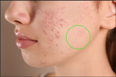 How To Remove Acne And Blemishes In Photoshop