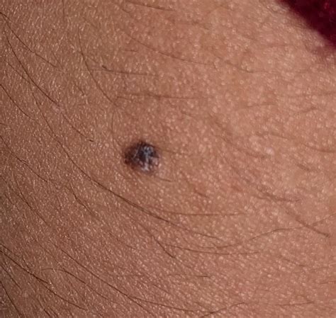 Should I Get This Mole Checked Out Ive Noticed Some White In It And