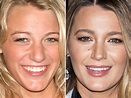Blake Lively Nose Job - Before and After