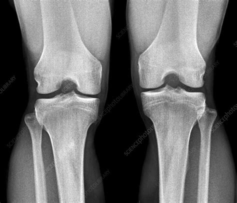 Normal Knees X Rays Stock Image F011 7590 Science Photo Library