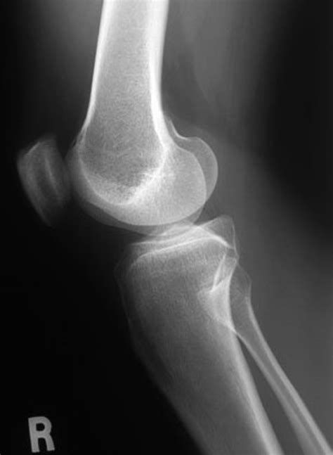 The horizontal beam lateral view allows identification of a knee joint effusion or lipohaemarthrosis (fat and blood in the joint). The Normal Knee X-ray: What Are the Different Views?