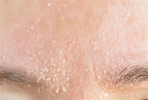 What Causes Dry Flaky Skin
