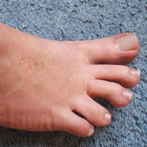5 Common Toe Problems And Their Causes Nailpro