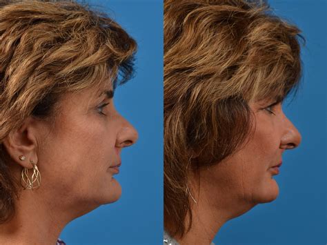 Mohs Surgery And Skin Cancer Photos Melbourne Fl Patient 54933