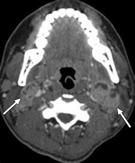 Imaging Of Cervical Lymphadenopathy In Children And Young Adults Ajr