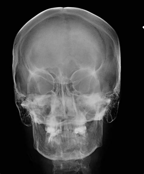 Medical Imaging Technology Skull Radiography Lateral And Pa Views My