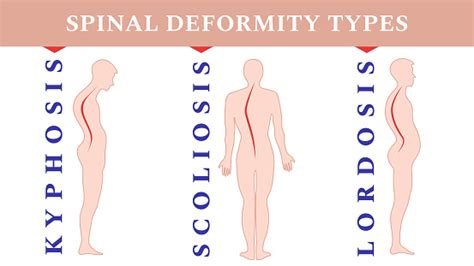 Diseases Of The Spine Scoliosis Lordosis Kyphosis Body Posture Defects