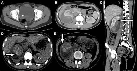 Adult With Infected Spontaneous Perinephric Urinoma Secondary To Uro Obstruction By Vuj Calculus