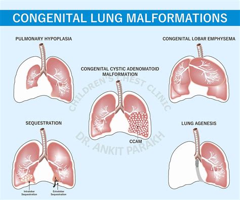 Congenital Lung Diseases Dr Ankit Parakh