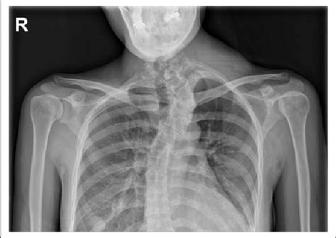 A Plain Radiograph Of Both Shoulders Showed Soft Tissue Swelling Left