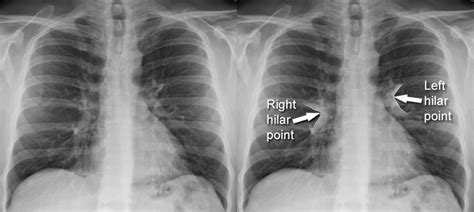 Chest X Ray Anatomy Hilar Structures