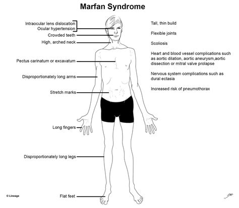 Marfan Syndrome Orthopedics Medbullets Step 2 3