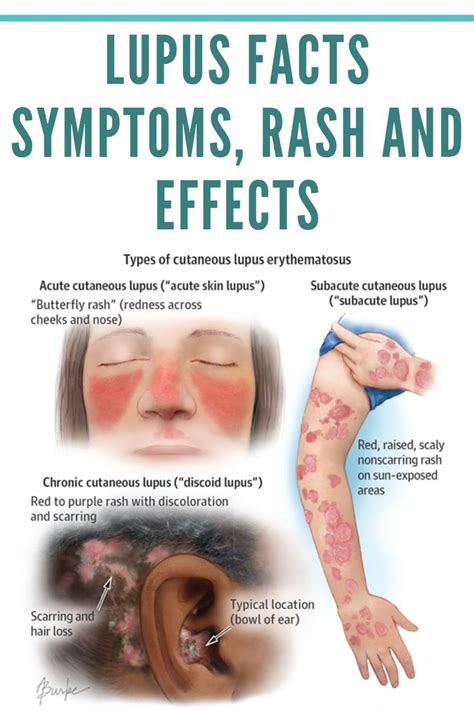 Lupus Facts Symptoms Rash And Effects Schoen Med In 2021 Lupus