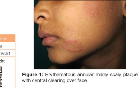 Figure 1 From Skindia Quiz 6 Multiple Recurrent Erythematous Scaly